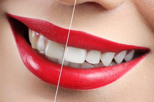 Antes y después del tiro de dientes rojos mujer blanqueamiento