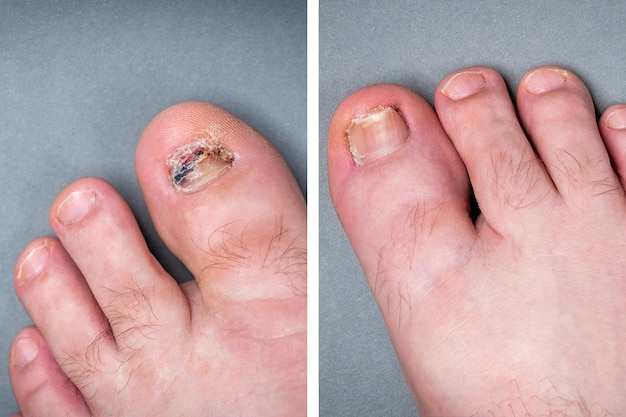 Antes y después del tratamiento para la infección por hongos en las uñas de los pies.