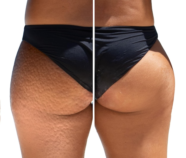 Foto antes y después de tratamientos exitosos de crema tópica y ultrasonido para eliminar la adiposidad