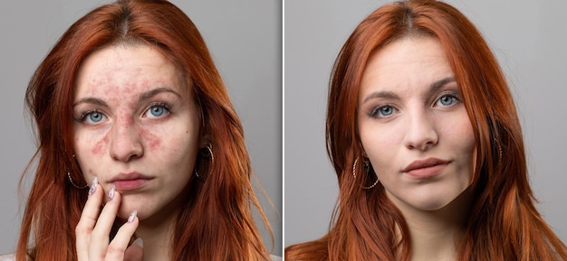 Foto antes e depois de um tratamento bem-sucedido de remoção de rosácea a laser