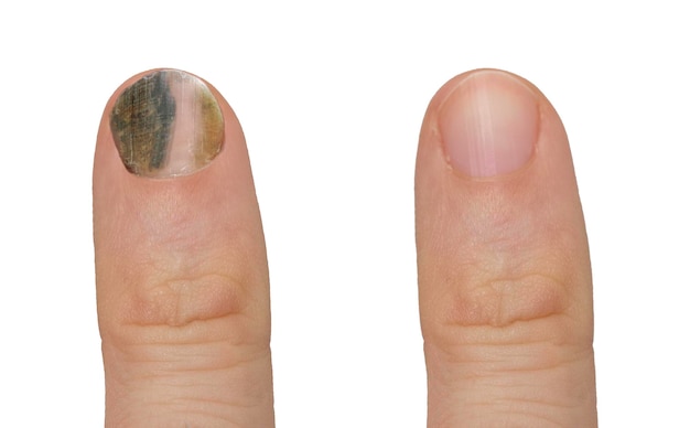 Antes e depois de um tratamento bem sucedido para uma infecção fúngica da unha frágil preta