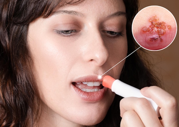 Antivirale Behandlung von Fieberbläschen Ein Mädchen hat einen Therapiezyklus mit einem Lippenstift