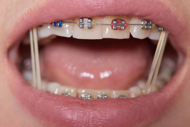 Los aparatos ortopédicos de primer plano en los dientes con elásticos Tratamiento de ortodoncia Vista delantera de los aparatos dentales