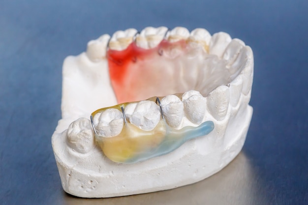 Aparelho dentário colorido em modelo de dentes de argila