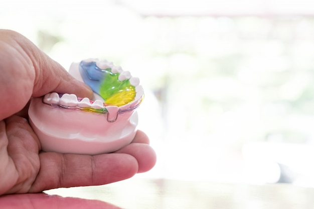Foto aparelho ortodôntico retentor dentário