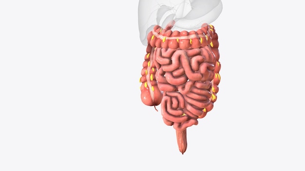 Los apéndices epiploicos son salidas normales de grasa peritoneal en la superficie antimesentérica del colon