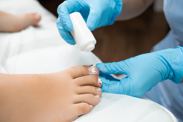 Aplicação de pó antibiótico nas unhas dos pés por um podólogo na clínica