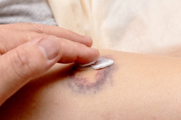 Aplicar ungüento sobre el hematoma. Tratamiento de hematomas