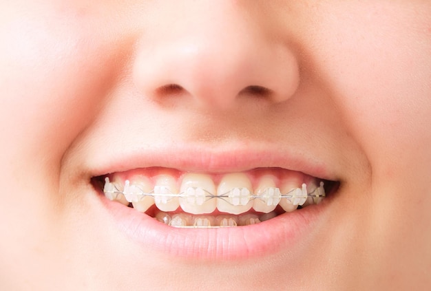 Aproximação da boca de uma adolescente branca sorrindo com alinhador dental branco invisível