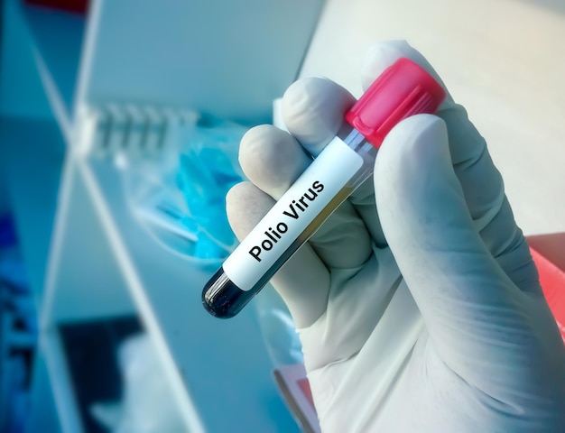 Aproximação da mão de cientista ou médico segura amostra de sangue para teste de vírus da poliomielite