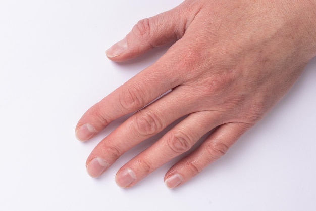 Aproximação de mãos femininas relacionadas à idade com unhas naturais quebradas e doentes, cutícula crescida demais