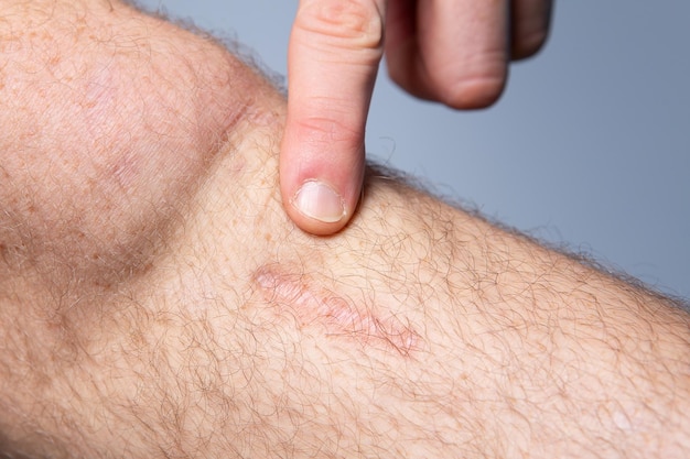 Aproximação de uma cicatriz antiga na perna masculina peluda caucasiana Dedo apontando para a velha laceraçãoxDxA