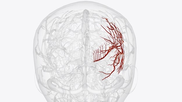 Foto arteria cerebral média direita e ramos