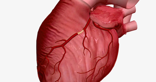 Arteriosklerose kann gefährlich sein, da Herz und Muskeln nur bei ausreichender Blutversorgung richtig funktionieren können