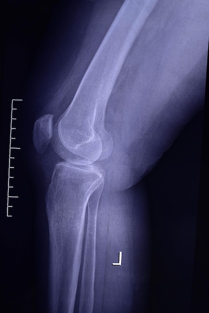 Artrosis de la articulación de la rodilla Imagen de radiografía