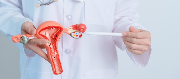 Arzt hält Uterus und Eierstöcke Modell Eierstock- und Gebärmutterhalskrebs Gebärmutterhalskrebs Endometriose Hysterektomie Uterusmyome Fortpflanzungssystem und Schwangerschaftskonzept