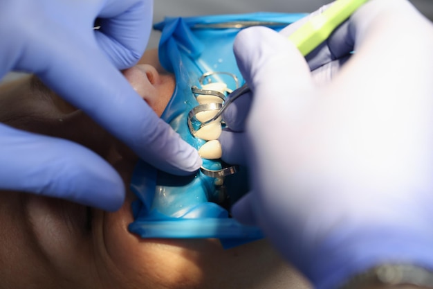 Arzt Zahnarzt repariert Veneer auf den Zähnen des Patienten mit Metallwerkzeugen in Nahaufnahme