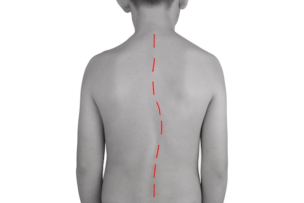 As costas de um menino com uma linha curva vermelha isolada em um fundo branco Vista traseira Chono foto branca Sinais de escoliose coluna curvada com escoliose Escoliose em crianças