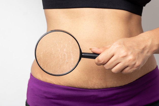 Foto as mulheres mostram a barriga após o nascimento estrias em fundo branco