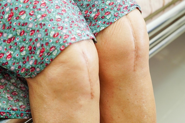 Asiatische ältere patientin mit narben-knieersatzoperation im krankenhaus