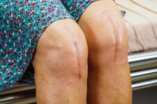 Asiatische ältere Patientin mit Narben-Knieersatzoperation im Krankenhaus