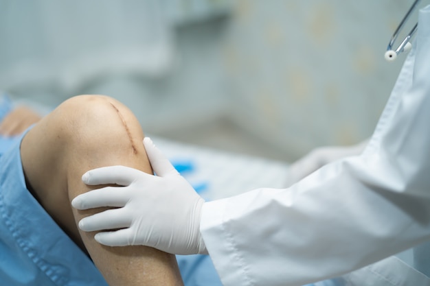 Asiatische ältere Patientin zeigen ihre Narben chirurgischen totalen Kniegelenkersatz.