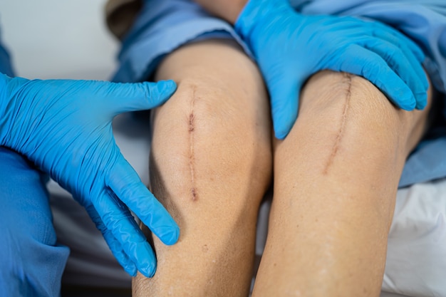 Asiatische ältere Patientin zeigen ihre Narben chirurgischen totalen Kniegelenkersatz.