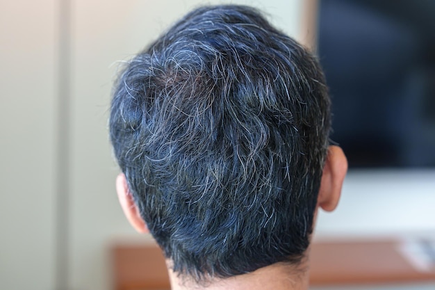 Asiatischer Mann mit grauem und weißem Haar, der aufwächst Haarproblemkonzept