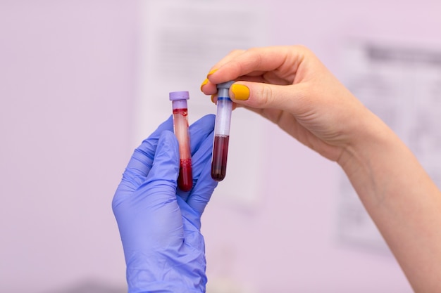 Assistente de laboratório em laboratório médico mantém tubo de ensaio com sangue e plasma na mão e fazendo análises.