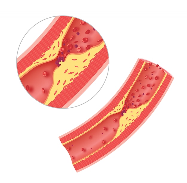 Foto atherosklerose in der arterie