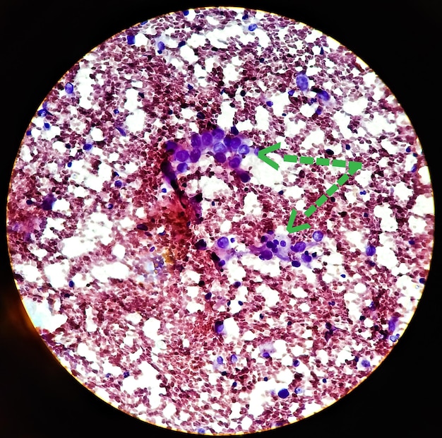 Axillärer Lymphknoten (FNA-Zytologie) Positive maligne Zelle, metastasierendes duktales Karzinom.