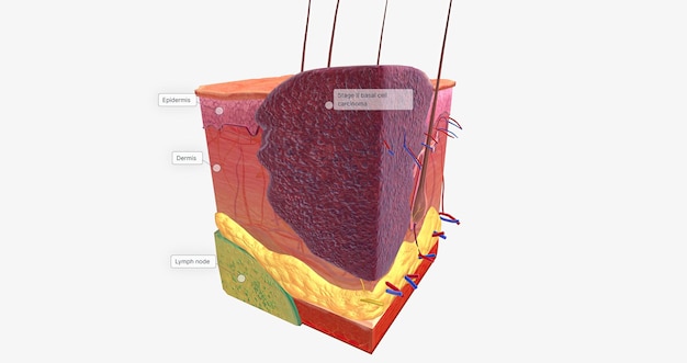 Foto basalzellkarzinom im gewebestadium ii
