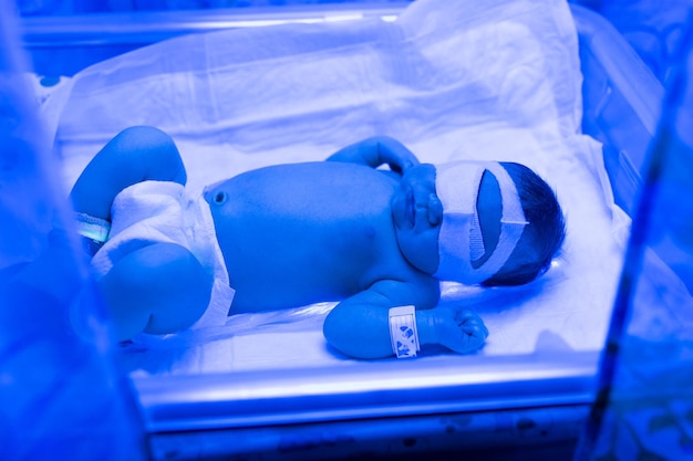 Un bebé recién nacido yace bajo lámparas ultravioleta bajo luz azul Tratamiento con bilirrubina alta de ictericia infantil incubadora ultravioleta