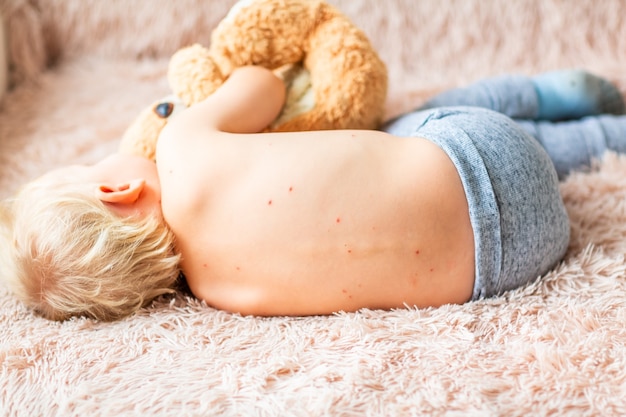 Bebezinho com vírus da varicela ou erupção na pele com bolhas de varicela em casa