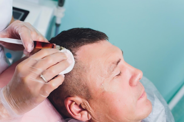 Behandlung von Haarausfall mit Schönheitsinjektionen Kosmetologe mit Handschuhen macht eine subkutane Injektion Plasmalifting männlicher Patient
