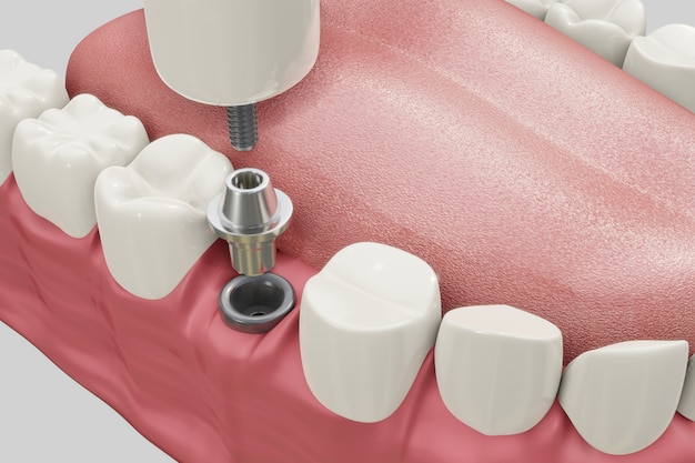 Behandlungsverfahren für Zahnimplantate. Medizinisch genaues 3D-Illustrationsprothesenkonzept.