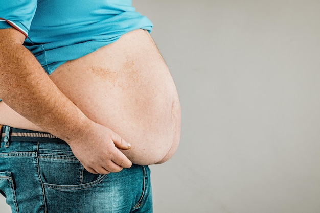 Übergewicht eines Personenkörpers mit Händen, die den Bauch berühren Das Konzept der Fettleibigkeit