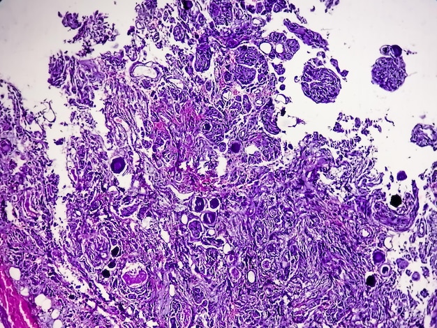 Biópsia de tumor espinhal mostrando meningioma psamomatoso. Corpos de psamoma.