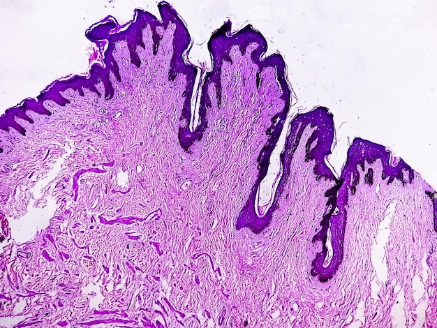 Foto biópsia histológica da parede escrotal à microscopia mostrando calcinose cutânea. calcinose escrotal.