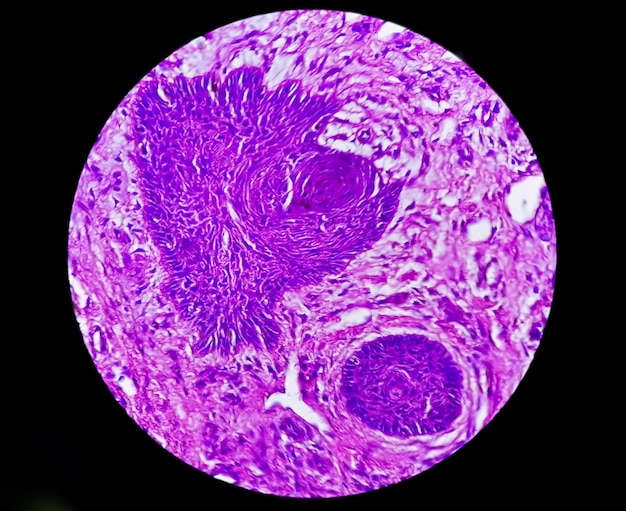 Biopsia de piel bajo microscopía sugestiva de carcinoma de células basales, el tipo más común de cáncer de piel