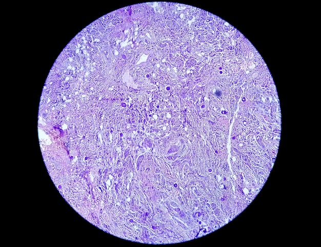 Biopsia de tumor espinal que muestra meningioma psamomatoso. Cuerpos de psamoma.