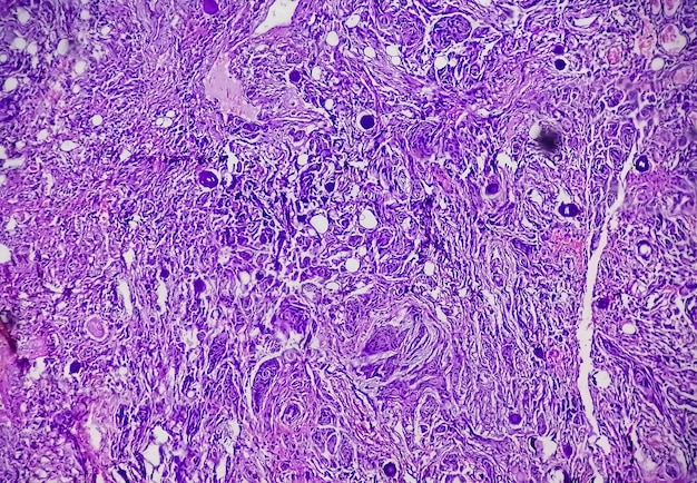 Biopsia de tumor espinal que muestra meningioma psamomatoso. Cuerpos de psamoma.