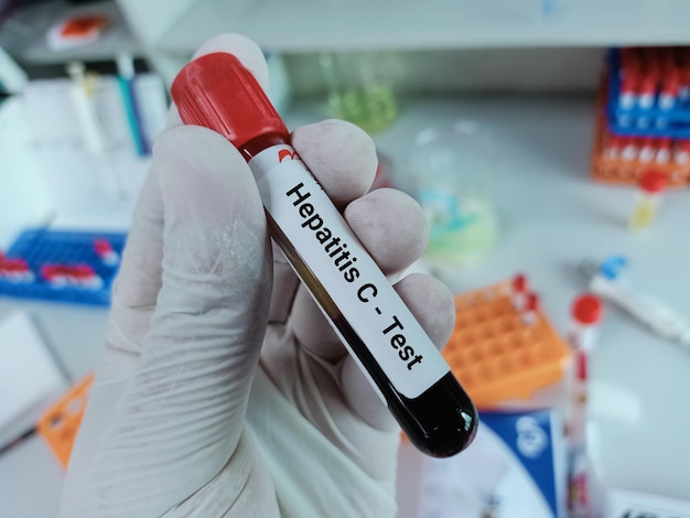 El bioquímico de un científico tiene una muestra de sangre para la prueba del virus de la hepatitis C (VHC),