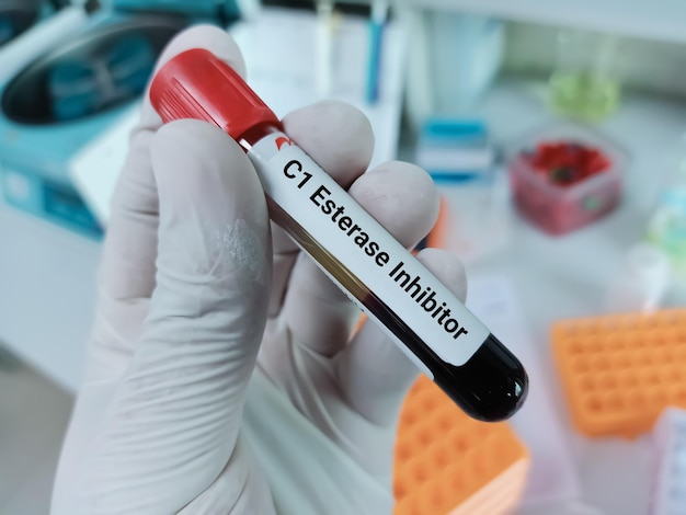 Bioquímico do cientista detém amostra de sangue para teste de inibidor de c1 esterase,