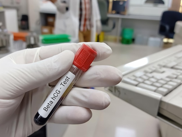 Bioquímico o tecnólogo de laboratorio tiene una muestra de sangre para una prueba de hormona beta hCG. Prueba de embarazo.