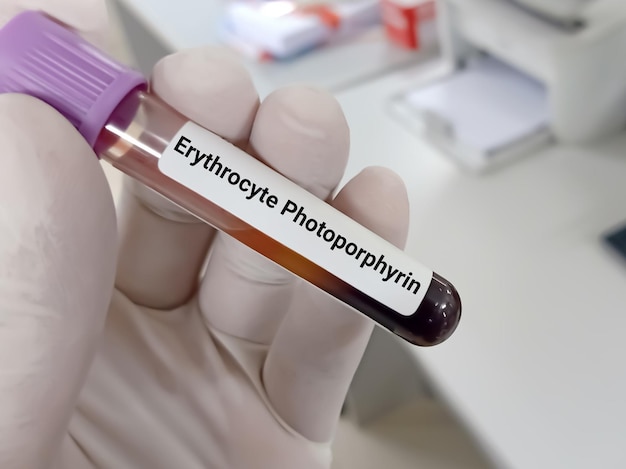 Foto bioquímico ou médico detém amostra de sangue para diagnóstico de teste de protoporfirina eritrocitária de anemia dis