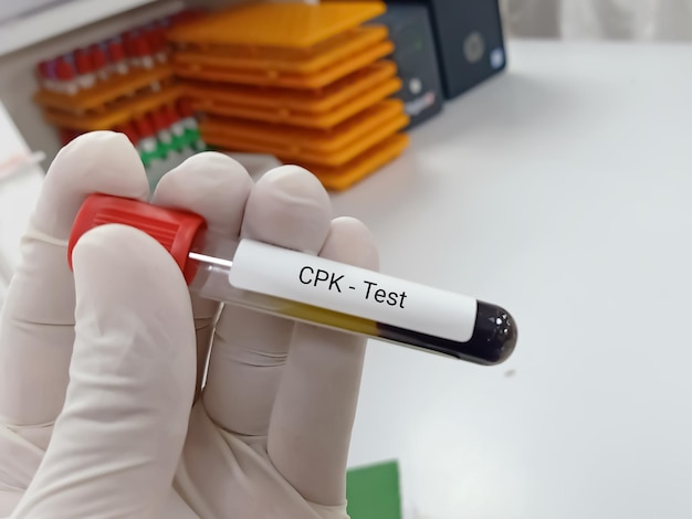 Foto bioquímico ou tecnólogo de laboratório detém amostra de sangue para teste de enzima creatina fosfoquinase (cpk).