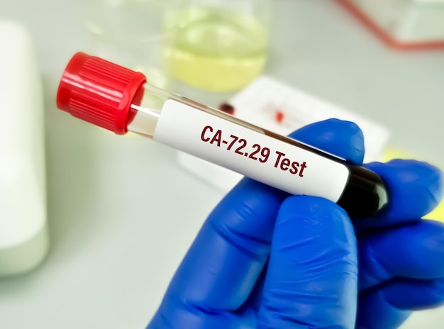 Bioquímico segura amostra de sangue para teste CA-27.29, diagnóstico de câncer de mama.