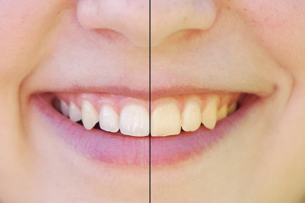 Foto blanqueo de dientes antes y después