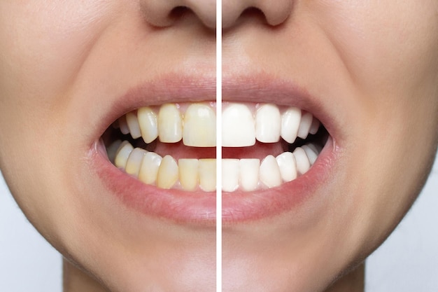 Blanqueo de dientes de mujeres de cerca antes y después del procedimiento Mandíbula superior e inferior Clínica dental